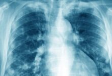 Photo of Lung cancer in non-smokers: Researchers discover possible cause and preventive drug