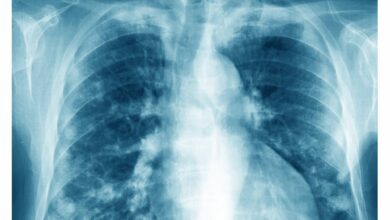Photo of Lung cancer in non-smokers: Researchers discover possible cause and preventive drug