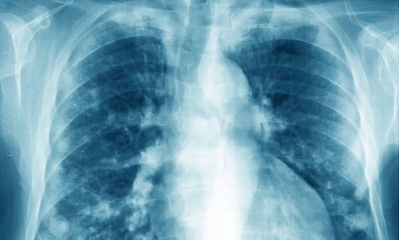 Lung cancer in non-smokers: Researchers discover possible cause and preventive drug